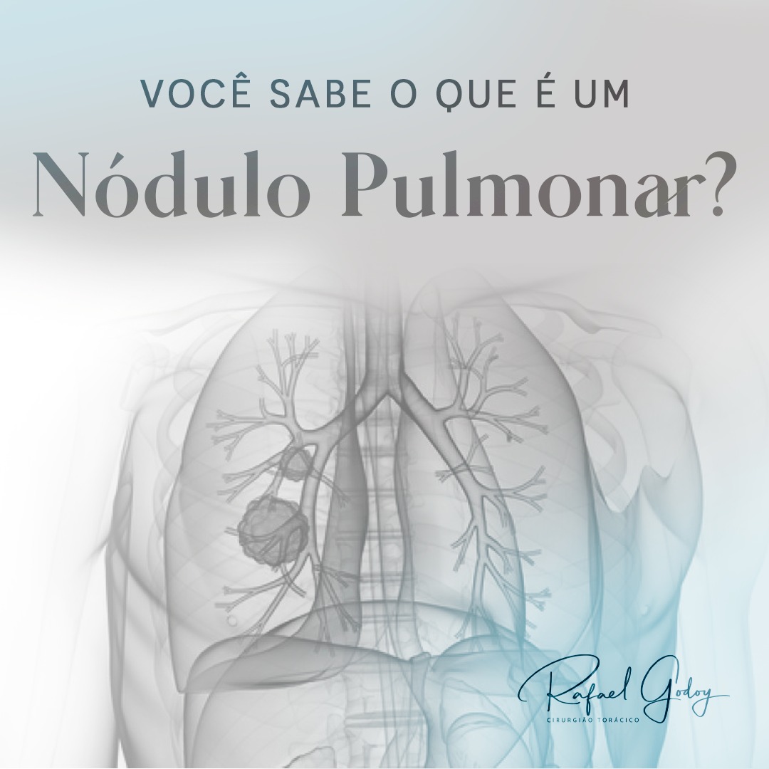 O que são Nódulos pulmonares?