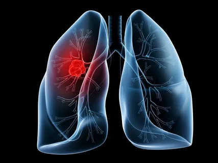 Nódulo Pulmonar e Câncer de Pulmão: Relação com o Cigarro e Opções de Cirurgia